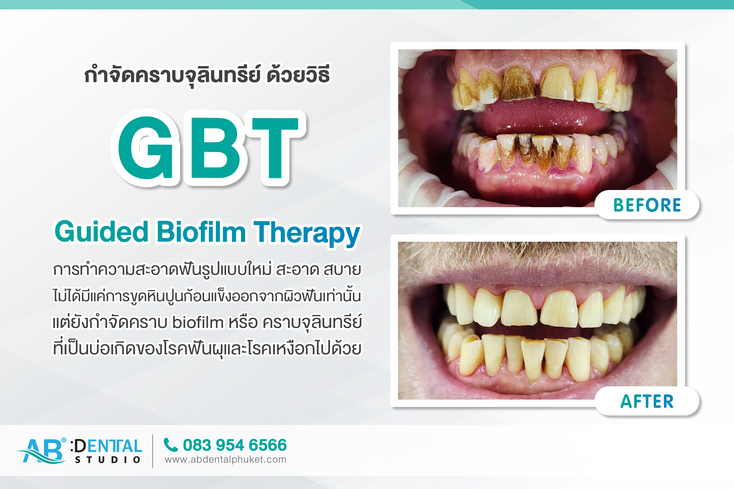 Guided Biofilm Therapy clinic,clinic phuket,gbt clinic,gbt,Guided Biofilm Therapy,dental phuket,ab dental phuket,ab dental