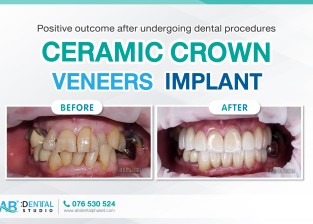 Ceramic crown, Veneers, and Implant services to meet patient needs