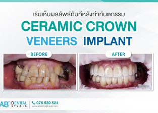 บริการ Ceramic crown, Veneers, Implant ตอบโจทย์คนไข้