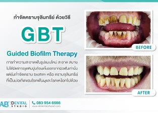 การทำความสะอาดฟันแบบใหม่กำจัดคราบจุลินทรีย์ ด้วยวิธี Guided Biofilm Therapy (GBT)