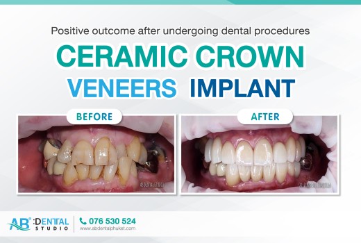 Ceramic crown, Veneers, and Implant services to meet patient needs