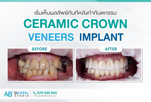 บริการ Ceramic crown, Veneers, Implant ตอบโจทย์คนไข้