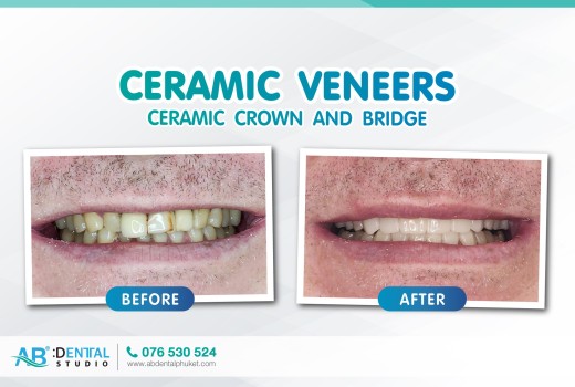 ก่อนและหลังทำทันตกรรมกับพวกเรา AB Dental Clinic Phuket กับบริการ Ceramic veneers , Ceramic crown and bridge.