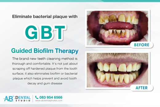 Eliminate bacterial plaque with Guided Biofilm Therapy (GBT)