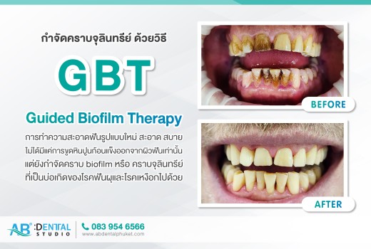 การทำความสะอาดฟันแบบใหม่กำจัดคราบจุลินทรีย์ ด้วยวิธี Guided Biofilm Therapy (GBT)