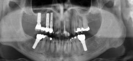 คลินิกทันตกรรม,คลินิกจัดฟัน, คลินิก จัด ฟัน ภูเก็ต, คลินิกทำฟัน ภูเก็ต, dental clinic, dental clinic phuket, phuket dental clinic, dental clinic near me, เอกซเรย์ฟัน ราคา, เอกซเรย์ฟันคุด, เอกซเรย์ฟัน ที่ไหน, วิธีเอกซเรย์ฟัน, เอกซเรย์ฟันคุด ราคา, Dental x ray machine, dental x-ray คือ, Panoramic x ray, Dental x ray slideshare